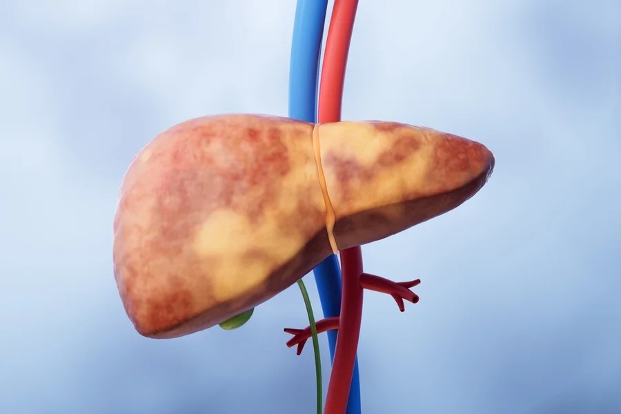 Câncer de fígado: alerta para diagnóstico precoce